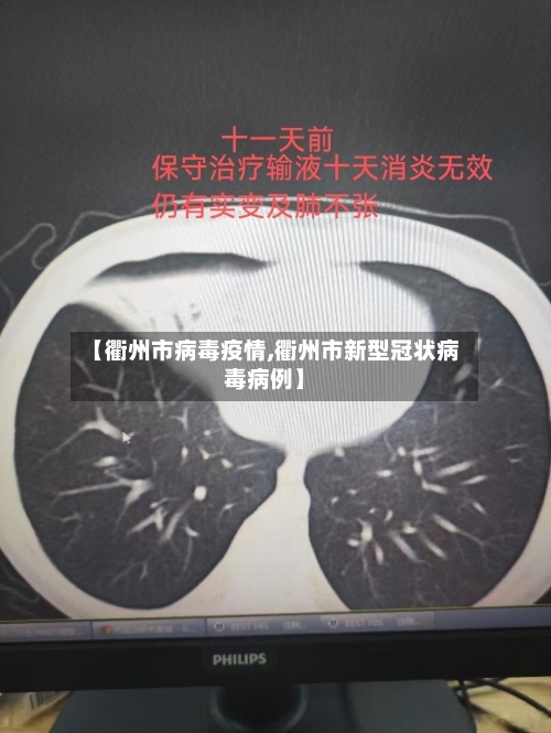 【衢州市病毒疫情,衢州市新型冠状病毒病例】